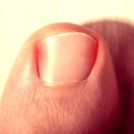 podiatrist ingrown toenail houston