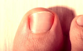 podiatrist ingrown toenail houston