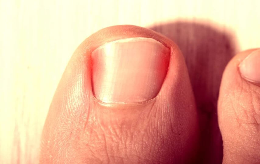 podiatrist ingrown toenail houston