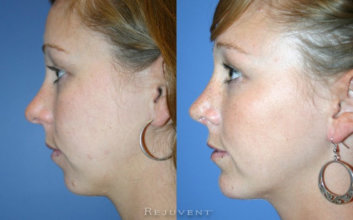 What You Need to Know About Chin Augmentation Surgery