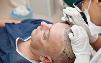 What is hair transplant surgery