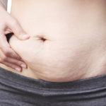 tummy tuck after pregnancy