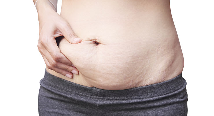 tummy tuck after pregnancy